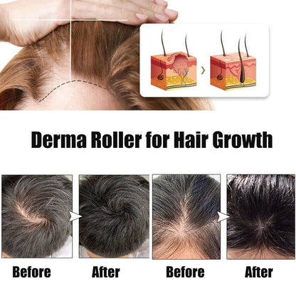 Advertisement for derma roller for hair growth with 'Before' and 'After' results.